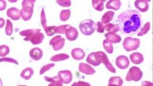 Sickle Cell Anemia -- not evidence for evolution