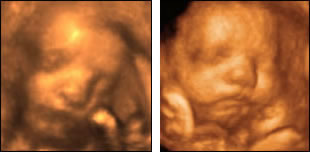 Unborn babies, 4D ultrasound, still shot